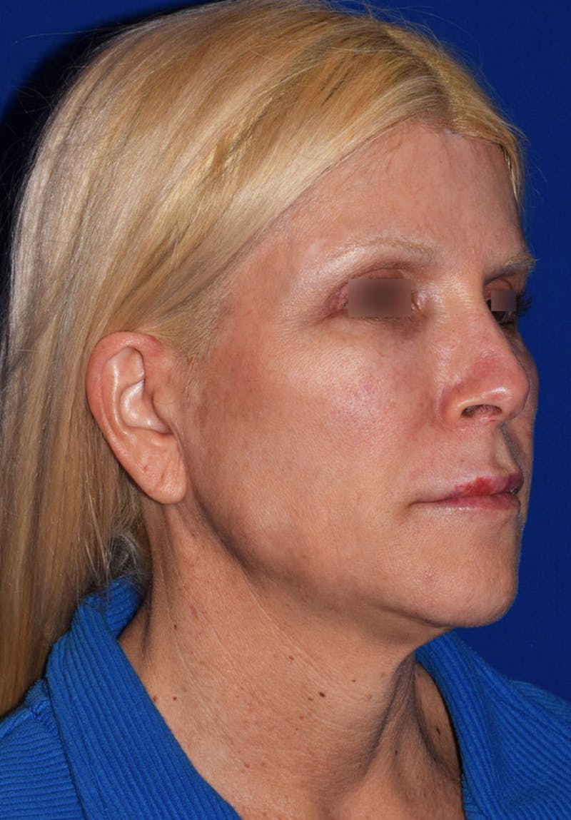 Facelift Before & After Gallery - Patient 801647 - Image 3
