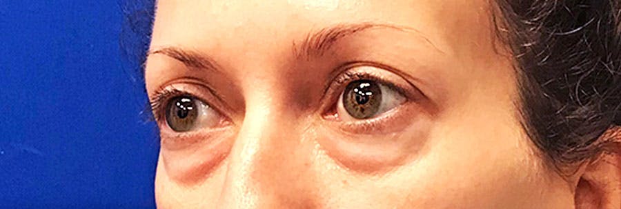 Lower Blepharoplasty Before & After Gallery - Patient 318980 - Image 3