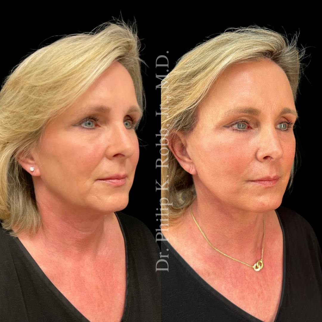 Upper Blepharoplasty Before & After Gallery - Patient 307713 - Image 2
