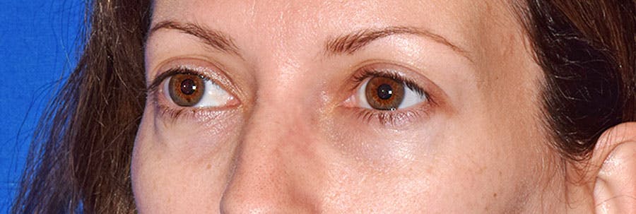 Lower Blepharoplasty Before & After Gallery - Patient 318980 - Image 4
