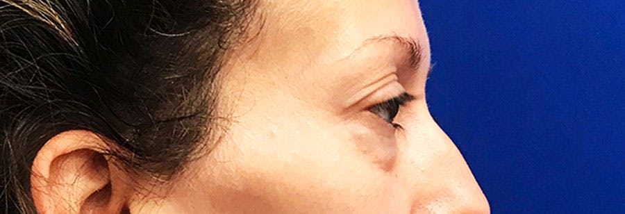 Lower Blepharoplasty Before & After Gallery - Patient 318980 - Image 5