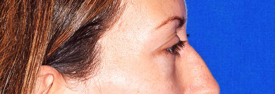 Lower Blepharoplasty Before & After Gallery - Patient 318980 - Image 6