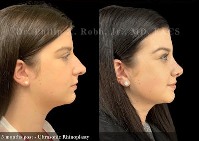 Ultrasonic Rhinoplasty Before & After Gallery - Patient 327688 - Image 1