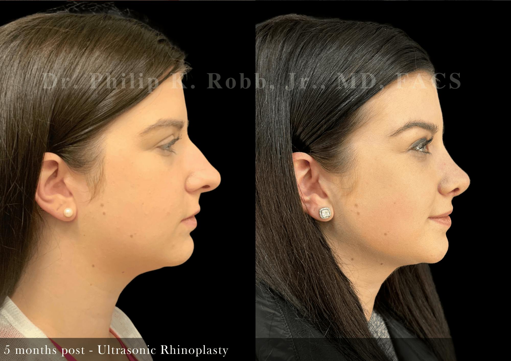 Ultrasonic Rhinoplasty Before & After Gallery - Patient 327688 - Image 1