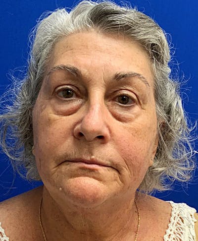 Lower Blepharoplasty Before & After Gallery - Patient 416079 - Image 1