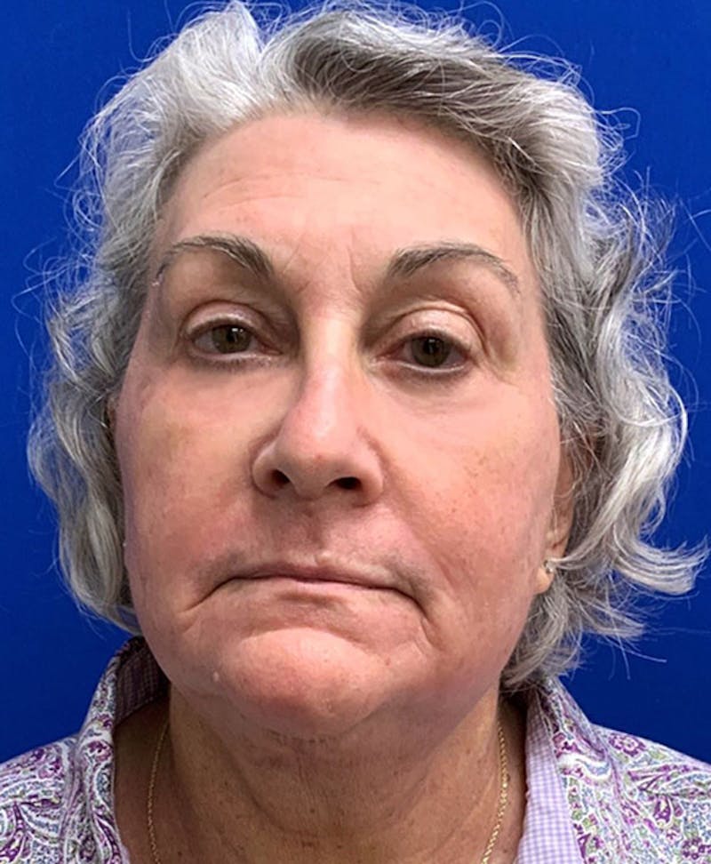 Lower Blepharoplasty Before & After Gallery - Patient 416079 - Image 2