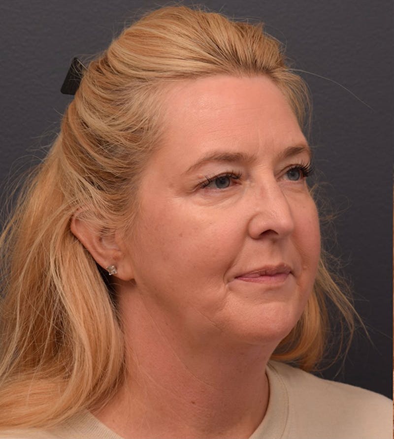Facelift Before & After Gallery - Patient 233743 - Image 7