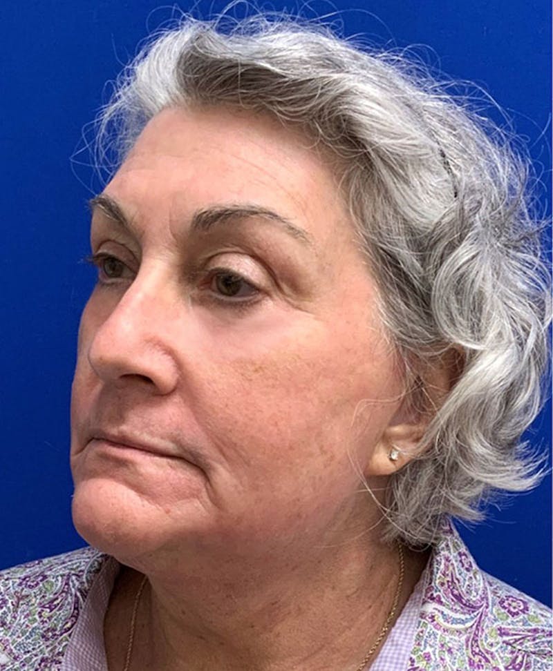 Lower Blepharoplasty Before & After Gallery - Patient 416079 - Image 4