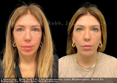 Laser Skin Resurfacing Before & After Gallery - Patient 277951 - Image 1