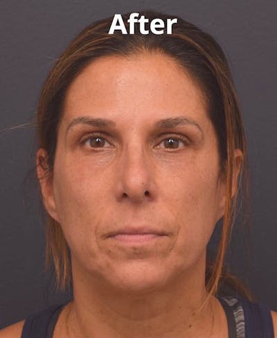 Upper Blepharoplasty Before & After Gallery - Patient 417671 - Image 2