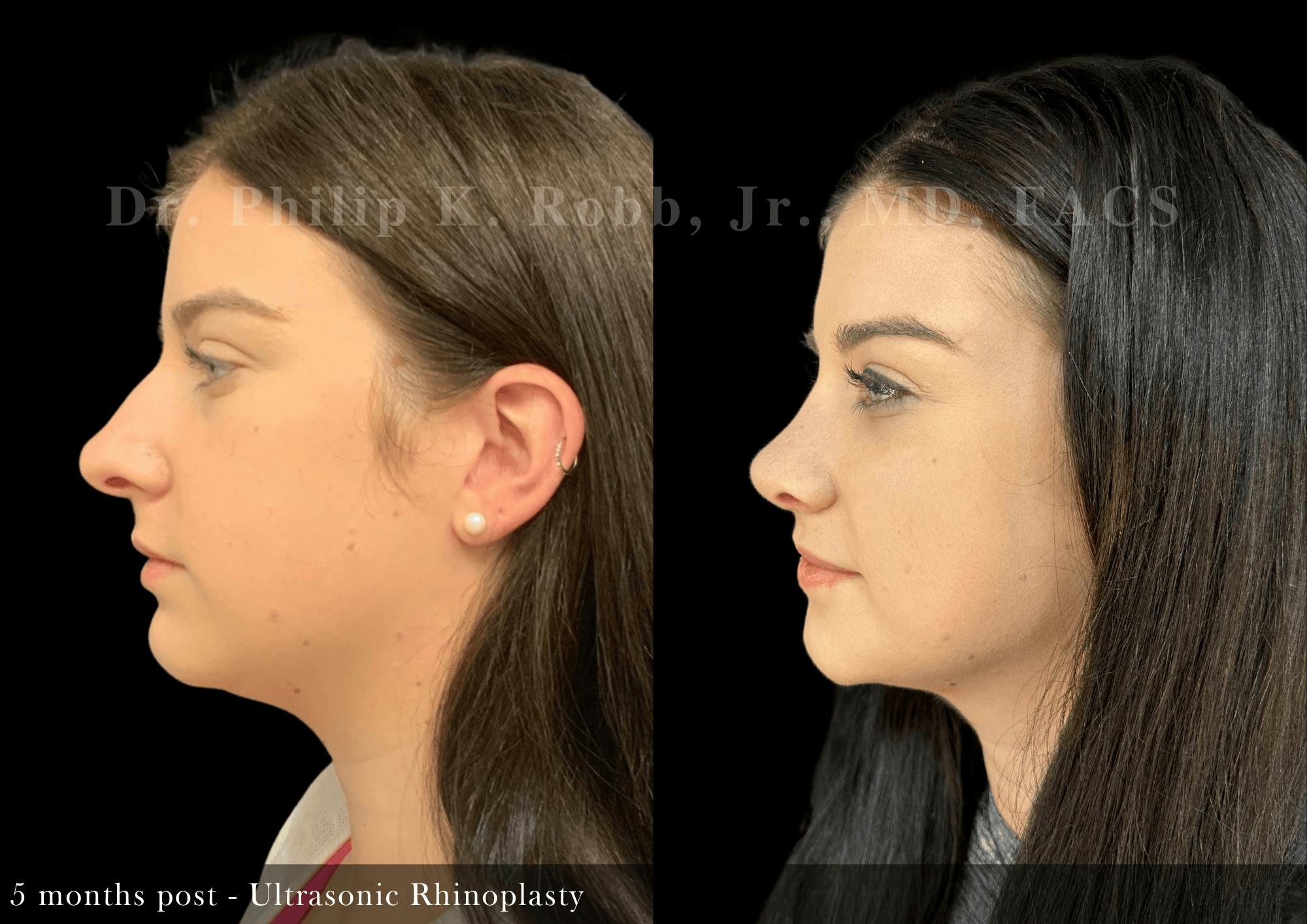 Ultrasonic Rhinoplasty Before & After Gallery - Patient 327688 - Image 5