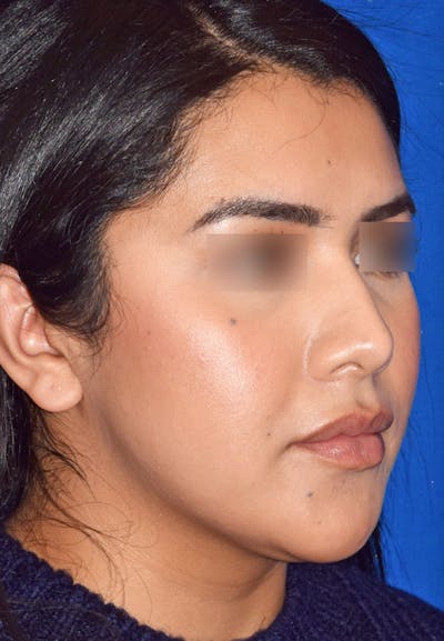 Buccal Fat Reduction Before & After Gallery - Patient 399133 - Image 1
