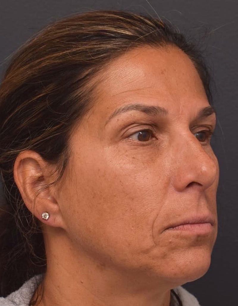 Upper Blepharoplasty Before & After Gallery - Patient 417671 - Image 3