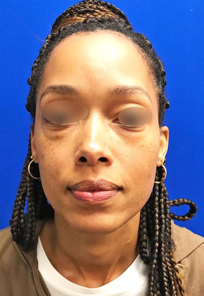 Lower Blepharoplasty Before & After Gallery - Patient 665132 - Image 1