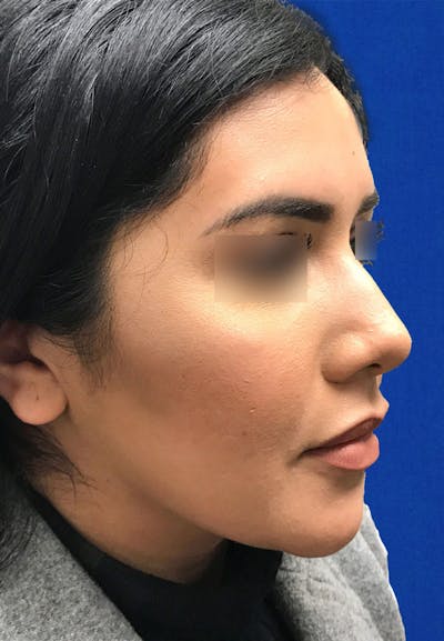 Buccal Fat Reduction Before & After Gallery - Patient 399133 - Image 2