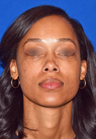 Lower Blepharoplasty Before & After Gallery - Patient 665132 - Image 2