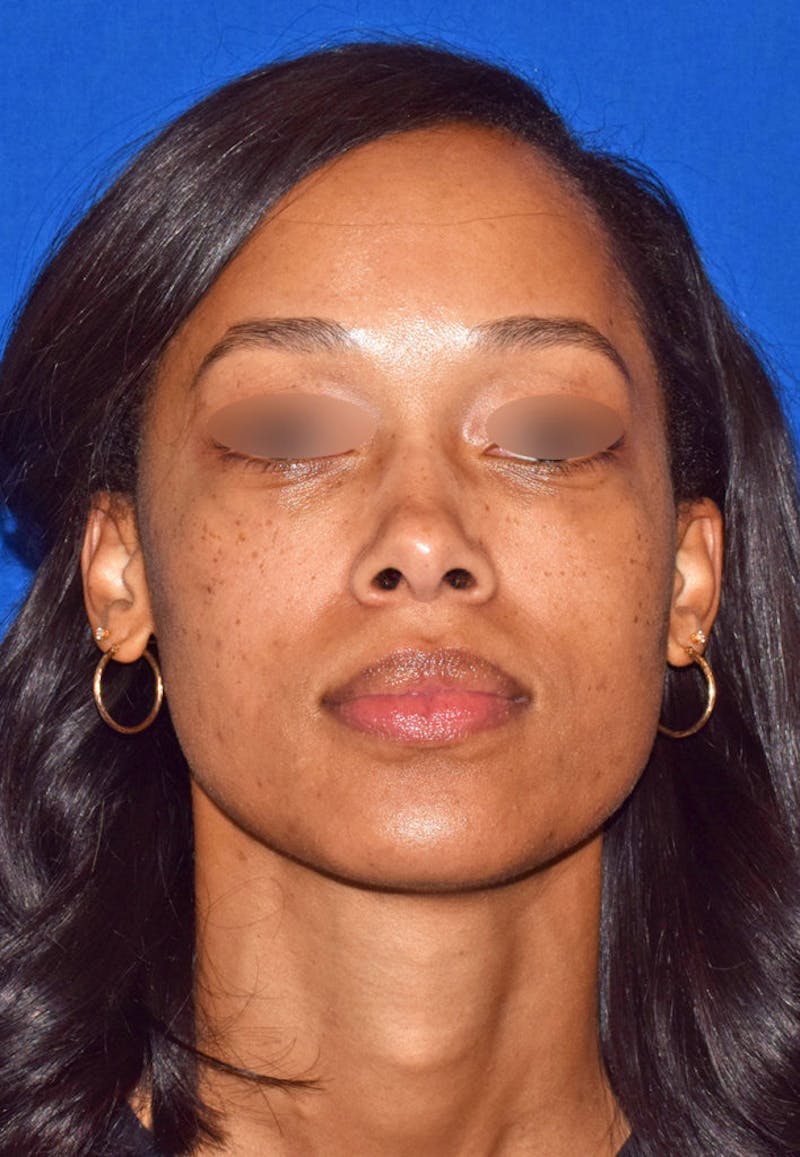 Lower Blepharoplasty Before & After Gallery - Patient 665132 - Image 2