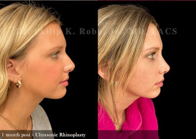 Ultrasonic Rhinoplasty Before & After Gallery - Patient 371291 - Image 1