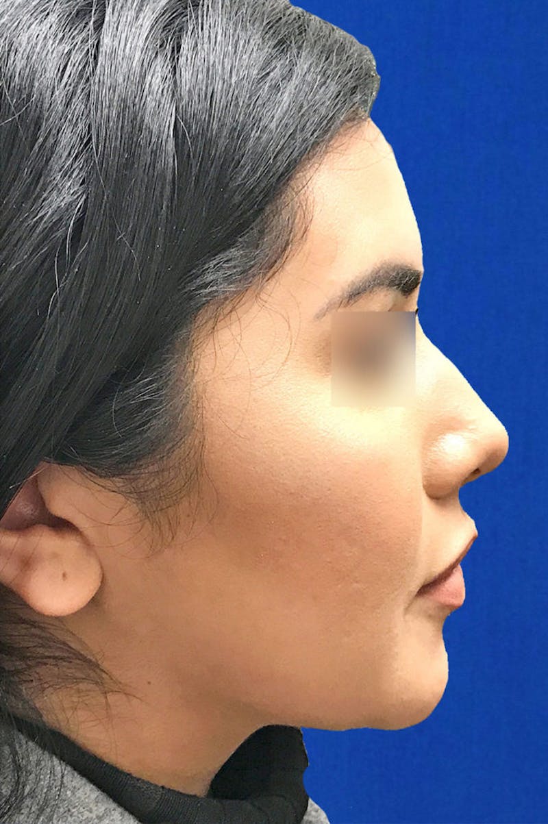 Buccal Fat Reduction Before & After Gallery - Patient 399133 - Image 4