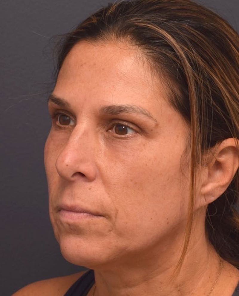 Upper Blepharoplasty Before & After Gallery - Patient 417671 - Image 6