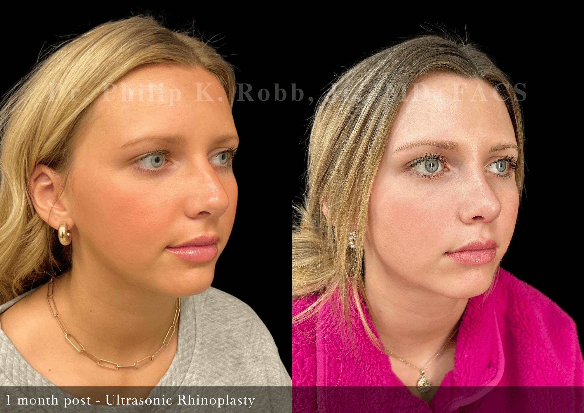 Ultrasonic Rhinoplasty Before & After Gallery - Patient 371291 - Image 2