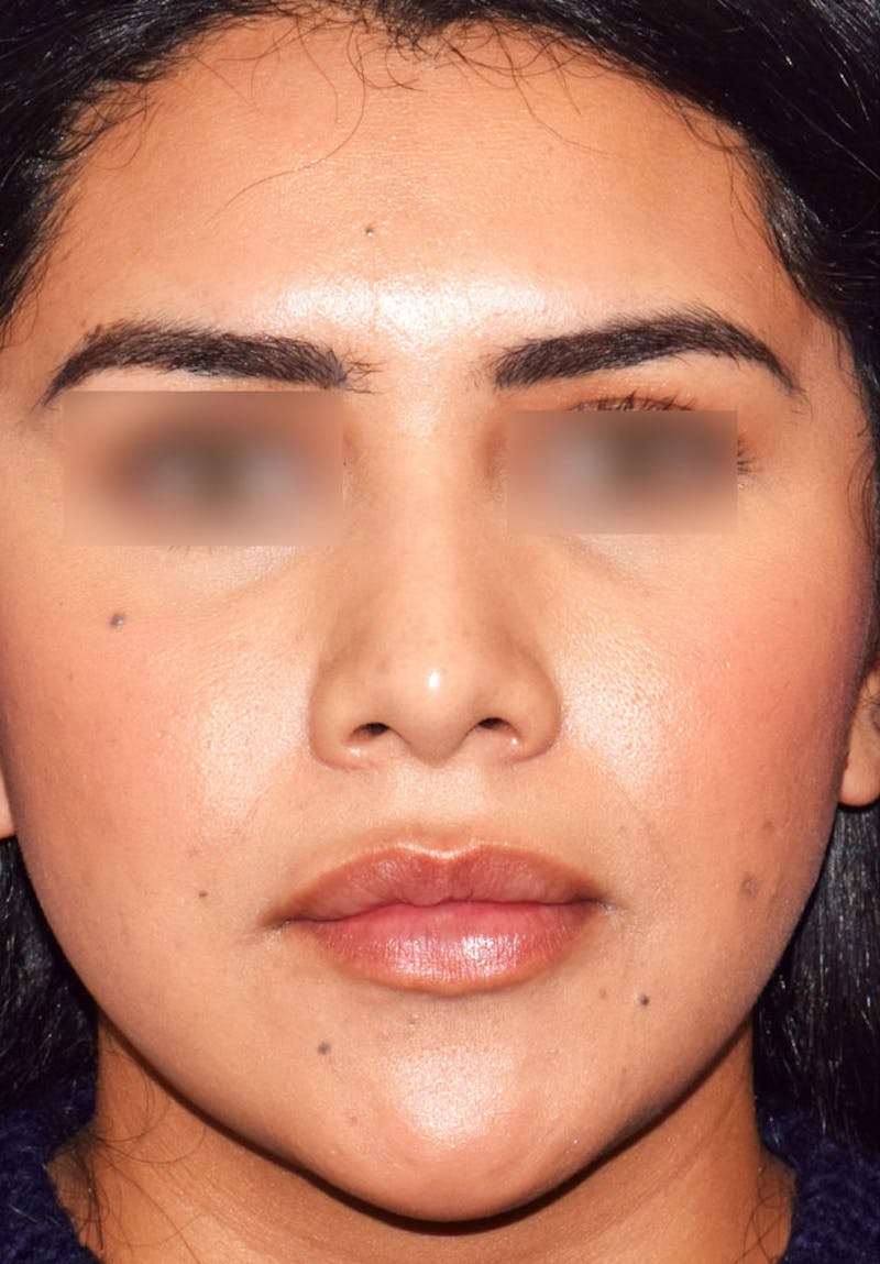 Buccal Fat Reduction Before & After Gallery - Patient 399133 - Image 5