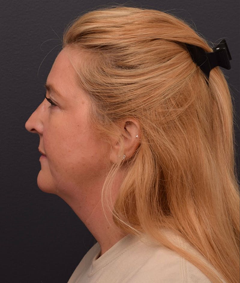 Facelift Before & After Gallery - Patient 233743 - Image 3