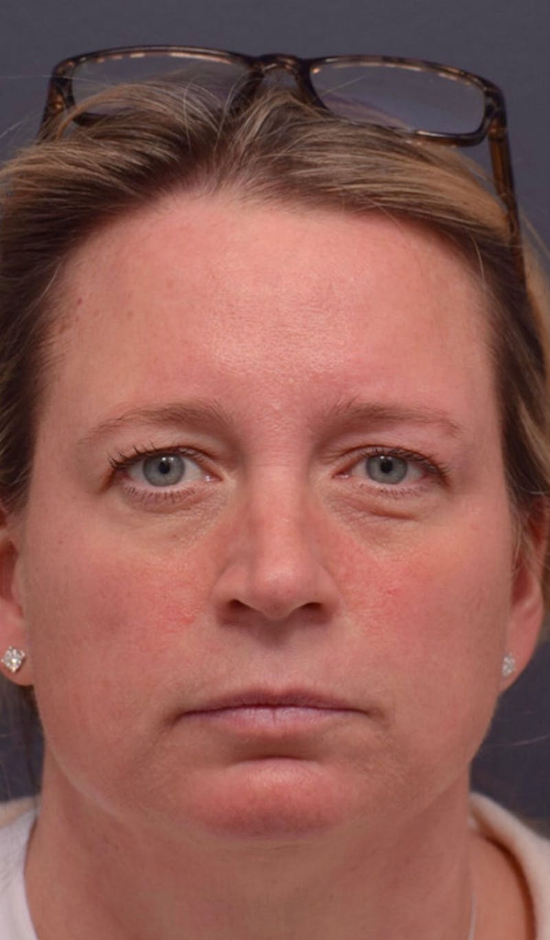 Upper Blepharoplasty Before & After Gallery - Patient 253997 - Image 1