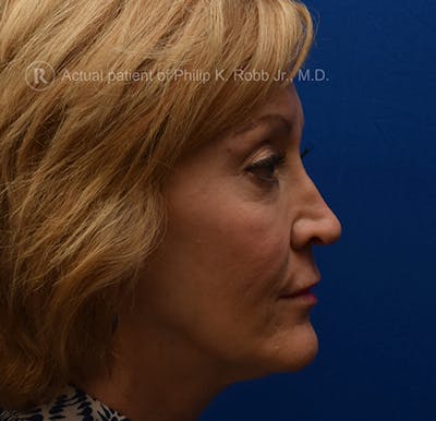 Lower Blepharoplasty Before & After Gallery - Patient 169700 - Image 1