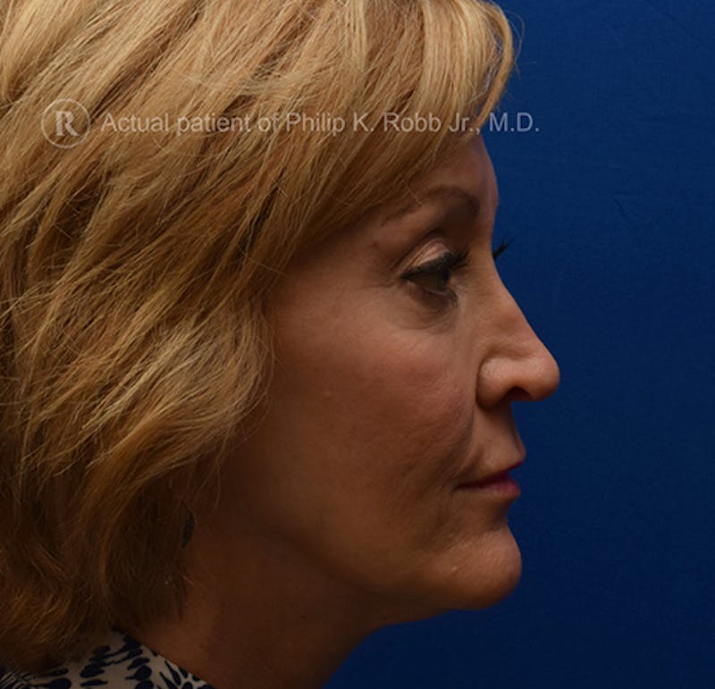 Lower Blepharoplasty Before & After Gallery - Patient 169700 - Image 1
