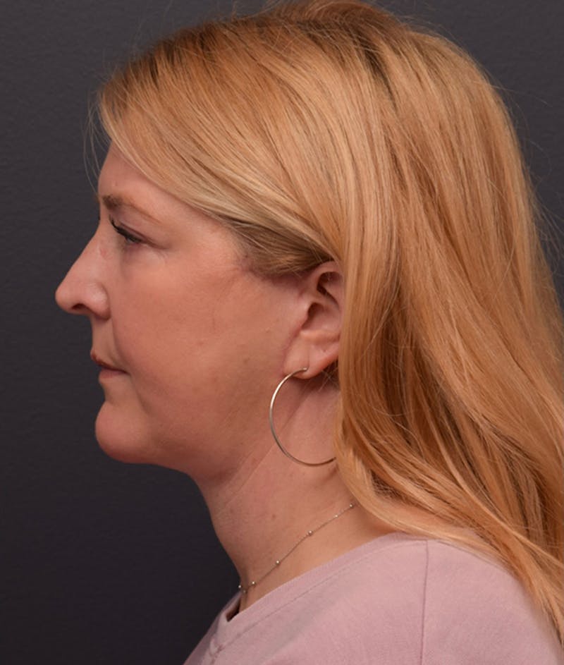 Facelift Before & After Gallery - Patient 233743 - Image 4