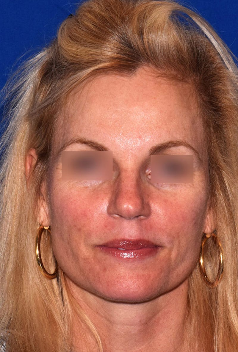 Buccal Fat Reduction Before & After Gallery - Patient 119864 - Image 1
