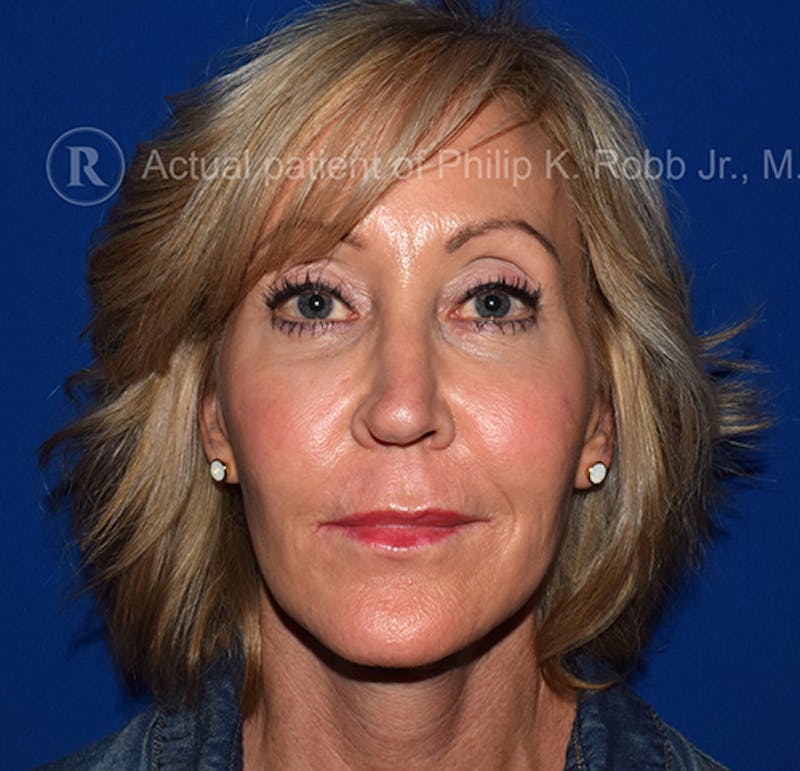 Lower Blepharoplasty Before & After Gallery - Patient 169700 - Image 4