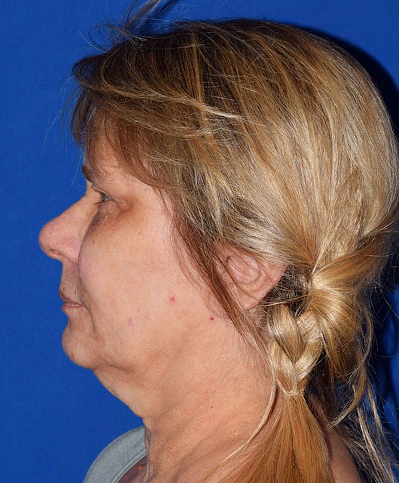 Upper Blepharoplasty Before & After Gallery - Patient 321249 - Image 5