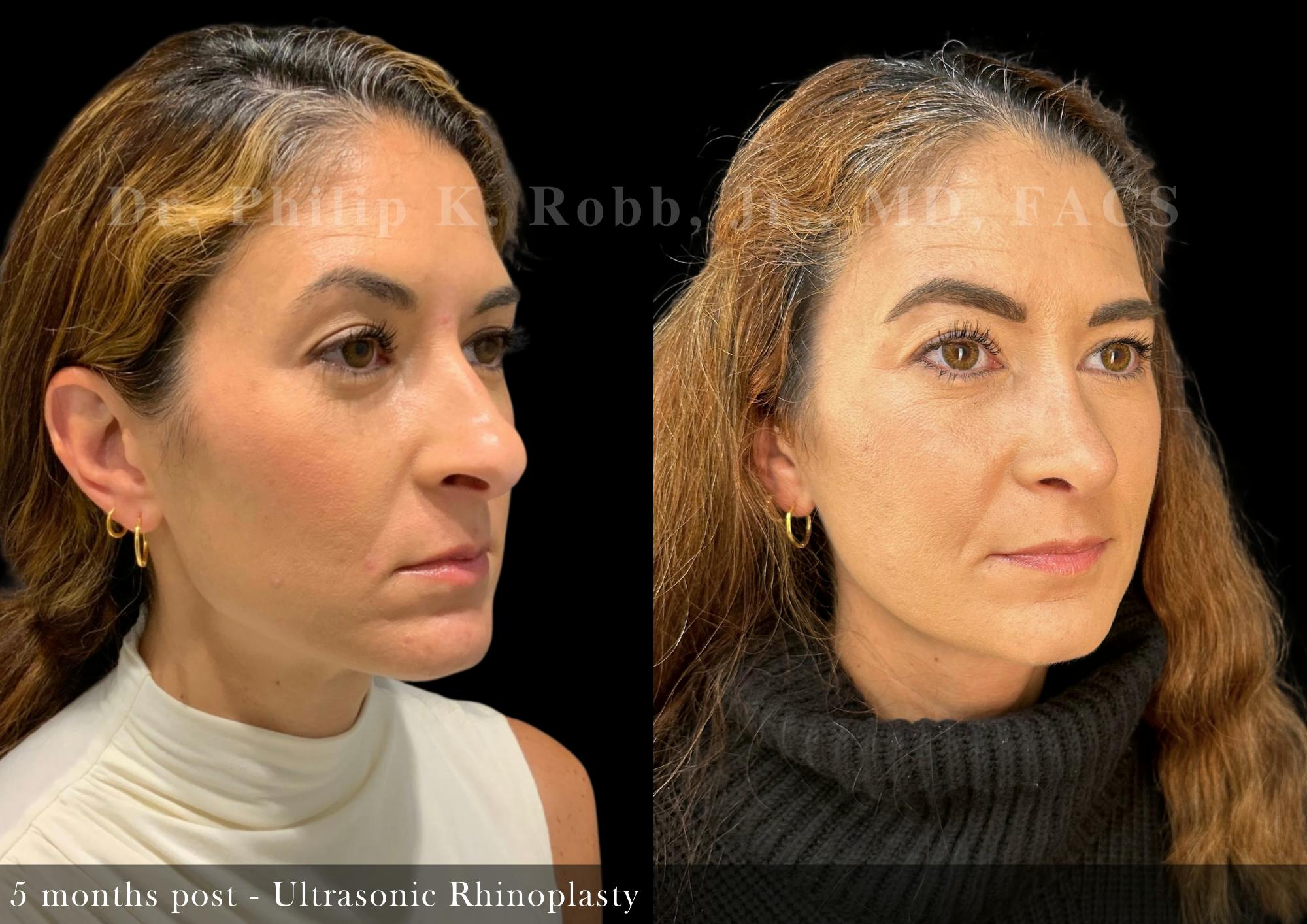 Ultrasonic Rhinoplasty Before & After Gallery - Patient 331222 - Image 2