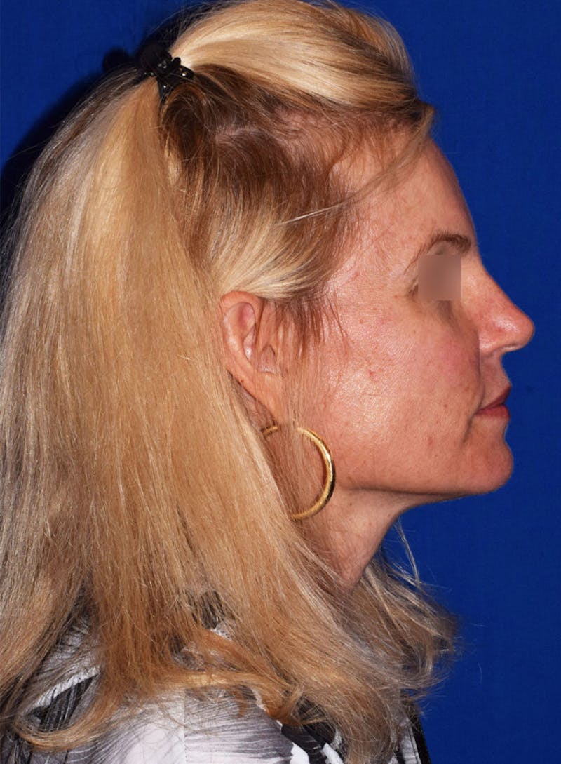Buccal Fat Reduction Before & After Gallery - Patient 119864 - Image 5