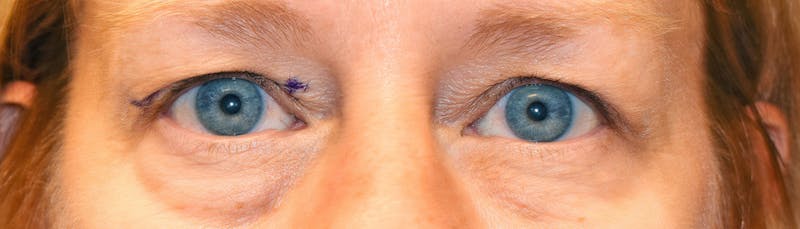 Upper Blepharoplasty Before & After Gallery - Patient 369644 - Image 1