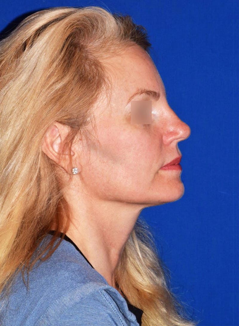 Buccal Fat Reduction Before & After Gallery - Patient 119864 - Image 6