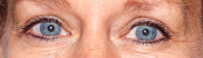 Upper Blepharoplasty Before & After Gallery - Patient 369644 - Image 2