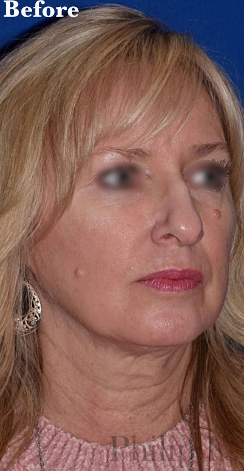 Facelift Before & After Gallery - Patient 295817 - Image 3