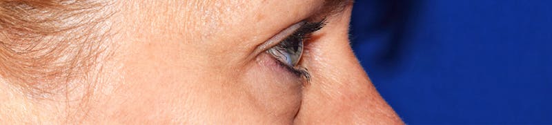 Upper Blepharoplasty Before & After Gallery - Patient 369644 - Image 4