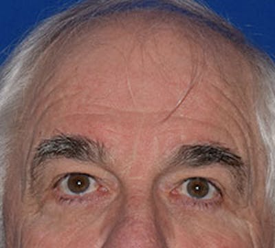 Upper Blepharoplasty Before & After Gallery - Patient 274717 - Image 2