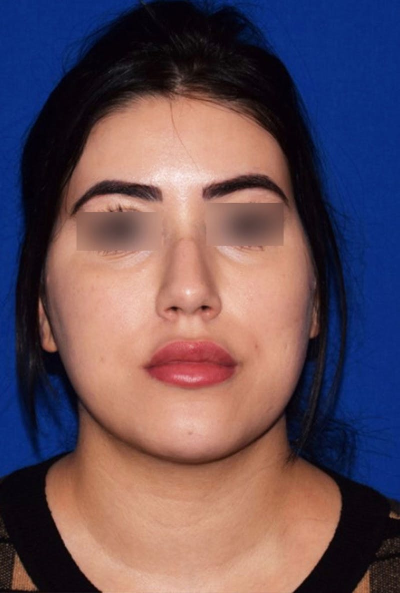 Buccal Fat Reduction Before & After Gallery - Patient 182534 - Image 1