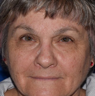 Upper Blepharoplasty Before & After Gallery - Patient 174853 - Image 2