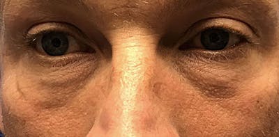 Lower Blepharoplasty Before & After Gallery - Patient 775466 - Image 1