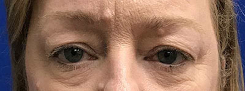 Upper Blepharoplasty Before & After Gallery - Patient 308152 - Image 1
