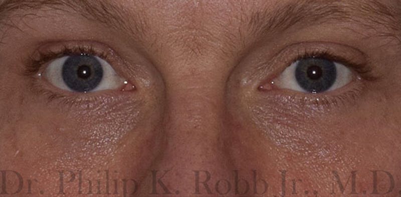 Lower Blepharoplasty Before & After Gallery - Patient 775466 - Image 2