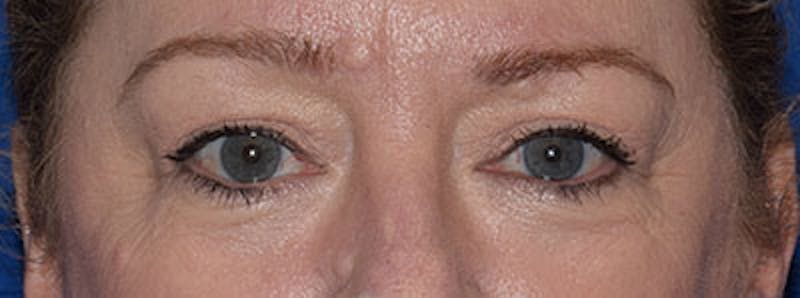 Upper Blepharoplasty Before & After Gallery - Patient 308152 - Image 2