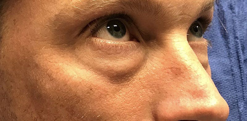 Lower Blepharoplasty Before & After Gallery - Patient 775466 - Image 3