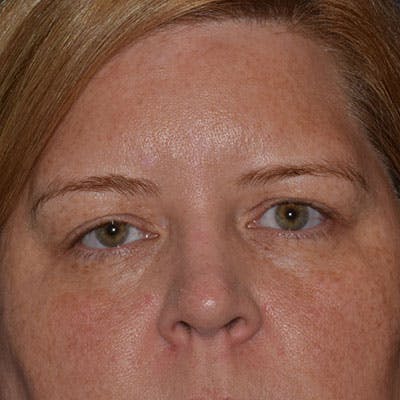 Upper Blepharoplasty Before & After Gallery - Patient 172281 - Image 1